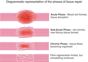 Hot or Cold Therapy for Soft Tissue Injury? 1 Tissue/injury repair stages