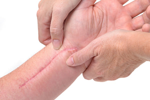 Massage 21 Scar work - treatment for scars